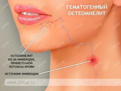 Есть ли остеомиелит? | Портал радиологов