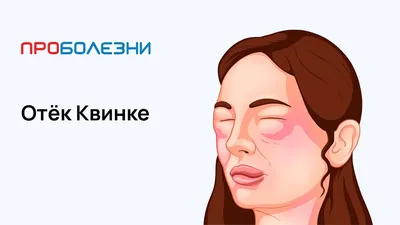 ⚕ Как помочь при отеке Квинке? - PULSE