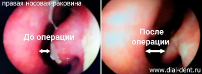 Прижигание слизистой носа для лечения вазомоторного ринита