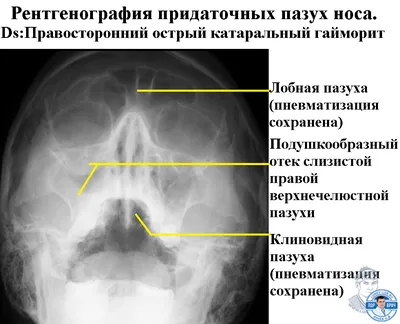 Киста в пазухе носа: как обнаружить и что делать?