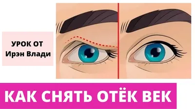 Ангионевротический отек век — аллергический отек Квинке у ребенка. Как  снять аллергический отек глаз