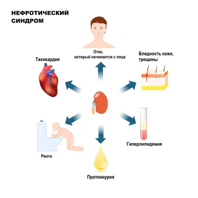 Нефротический синдром - причины появления, симптомы заболевания,  диагностика и способы лечения