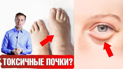 Болезни почек 👉 7 признаков. Лучшие и худшие продукты для почек - YouTube