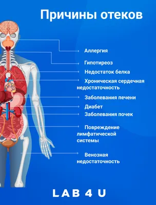 Причины отечности - статьи Lab4u.RU