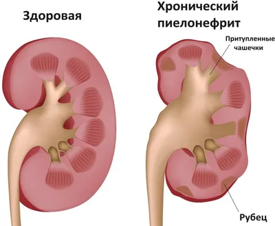 Гломерулонефрит - причины появления, симптомы заболевания, диагностика и  способы лечения