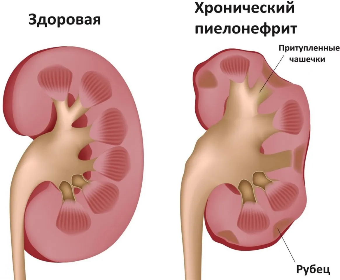 Каликоэктазия почек у детей