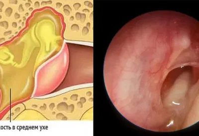 Хронический средний отит