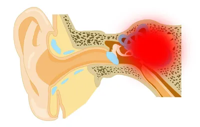 Отит: признаки, симптомы, лечение - МедКом