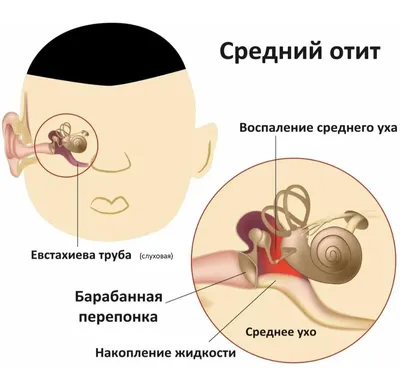 Отит у ребенка: симптомы и лечение. Признаки, причины и диагностика болезни.