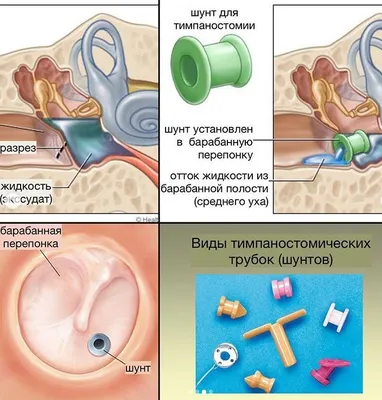 Лекарственные препараты при отите: виды средств, отличия, какое лучше?