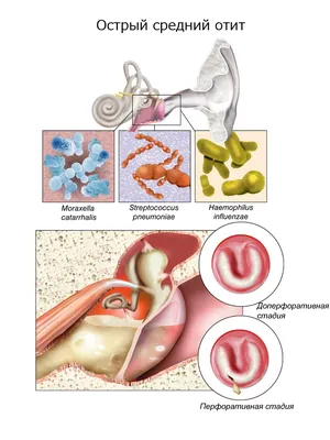 Острый средний отит - Лор Центр