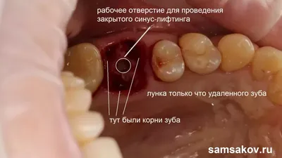 Закрытый синус-лифтинг: увеличение объема костной ткани для имплантатов  зубов