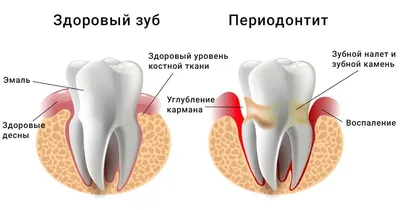 Лечение периодонтита зуба [цены, причины и симптомы]