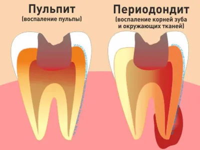 Открытый канал зуба фото