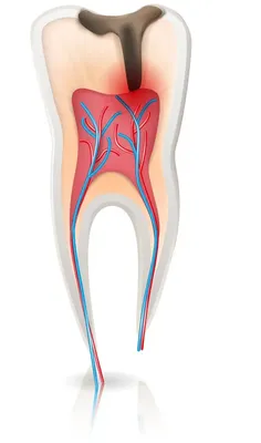 Чистка каналов зуба - Стоматология \"Алекс\" в Жуковском