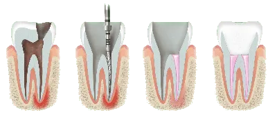 Перфорация канала зуба: особенности лечения