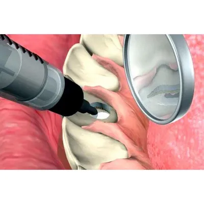 Что такое чистка каналов зуба | НАВА