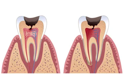 Абсцесс зуба - что такое абсцесс зуба: причины, лечение, симптомы