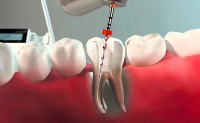 Перелечивание каналов зуба, стоимость в стоматологии Дантистофф в Москве