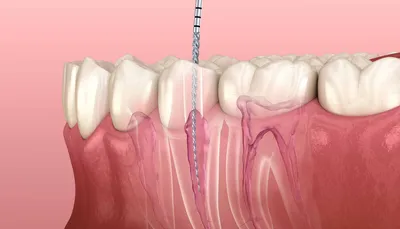 Апикальная микрохирургия, как возможность спасения зуба | Детская и  семейная стоматологическая клиника \"Белая Медведица\" | Санкт-Петербург