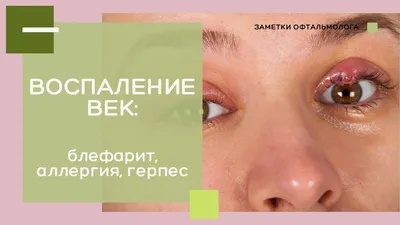 Удаление халязиона - «Как выглядит веко спустя 12 лет после операции» |  отзывы