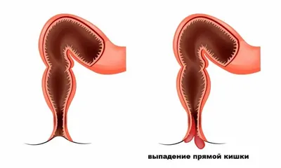 Воспаление Под Языком Болит Шишка 9 Фото ЛюмиДент