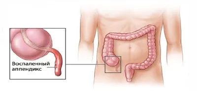 Заболевания червеобразного отростка — (клиники Di Центр)