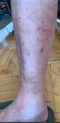 Лишай отрубевидный (Pityriasis versicolor, tinea versicolor) реферат по  медицине | Сочинения Медицина | Docsity