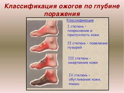 Что делать после ожога: лечение кожи и средства для заживления ран