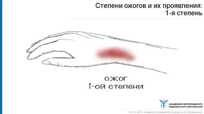 Ожоги - причины, симптомы, диагностика и лечение в Москве