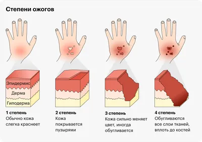 Лечение ожогов в домашних условиях: чем обработать, средства, как оказать  первую помощь