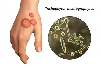 Соколова 2015 Эпидермофития крупных складок  KlinicheskayaDermatologiya_2015_01_044