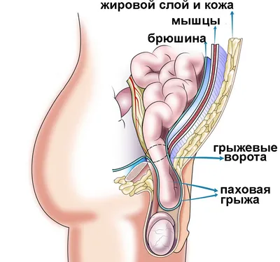 🏥 ✓Лечение паховой грыжи ⋆ 2023