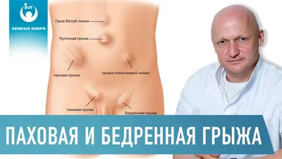 kherson_surgery - Паховая грыжа – это болезненное состояние, которое  сопровождается выпадением внутренних органов, в основном, кишечника,  большого сальника и яичников (у женщин) через брюшную стенку в паховый  канал. У женщин в нем