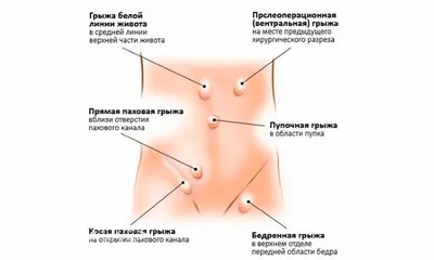 zavertylenko_md - Лапароскопия. Паховая грыжа На фото - внешний вид живота  на следующий день после лапароскопической пластики паховой грыжи у мужчины.  Да, этот пост без страшилок в стиле «до и после». Операция