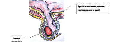 Паховая грыжа: симптомы, диагностика, лечение | gormoniya