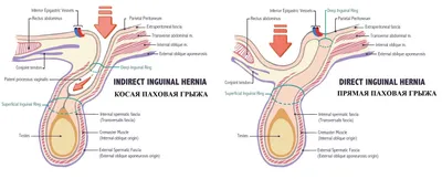 Паховая грыжа: причины, лечение — Благотворительный фонд помощи  недоношенным детям «Право на чудо»