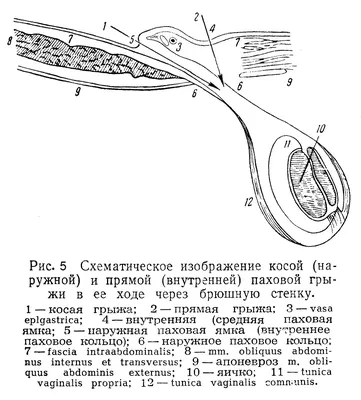 Паховая грыжа у мужчин