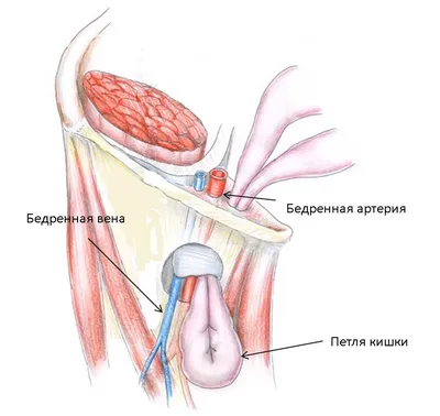 Почему возникает паховая грыжа: опасна ли она и всегда ли нужна операция? |  О здоровье: с медицинского на русский | Дзен