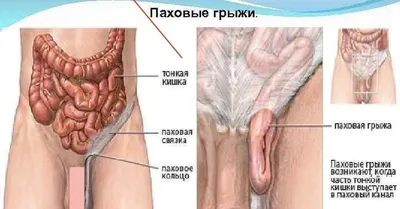 Ультразвуковая диагностика субклинических форм паховой грыжи на  противоположной от односторонней грыжи стороне у детей – тема научной  статьи по клинической медицине читайте бесплатно текст  научно-исследовательской работы в электронной библиотеке ...