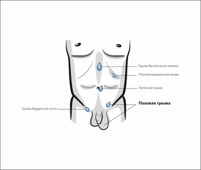 Паховая грыжа: симптомы, диагностика, лечение | gormoniya