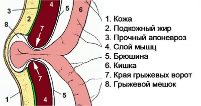 Паховая грыжа: почему появляется, как лечат и какую опасность представляет?  - Медицинский центр \"Допомога+\"