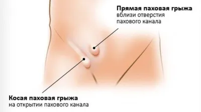 Фотогалерея \"Паховая грыжа\" — Лечение грыжи живота, операция, удаление грыжи  в Киеве - Хирург Рейзин Денис