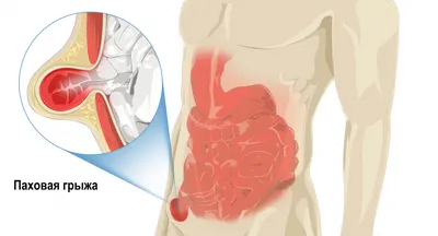 Паховая грыжа у мужчин