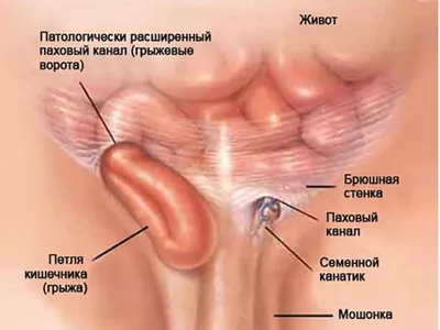 Паховая и бедренная грыжа - Новая мировая хирургия