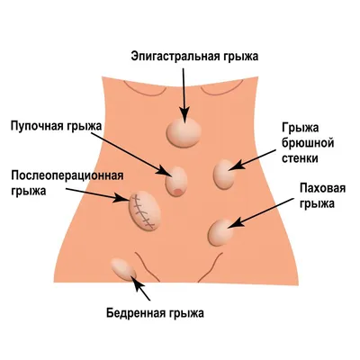 Паховая грыжа: симптомы, диагностика, лечение | gormoniya