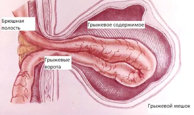 Центр хирургии грыж. Современные методы лечения паховой грыжи. | Москва