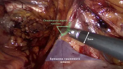 Лечение паховой грыжи, стоимость в Казани Майя Клиник