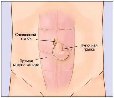 Операция по удалению паховой грыжи - «По роще калиновой, по роще осиновой,  На именины к щенку. В шляпе малиновой шел ежик резиновый С дырочкой в  правом боку.» | отзывы