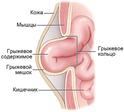 Хирургическое удаление грыжи в Киеве: стоимость удаления грыжи в клинике  Оксфорд Медикал